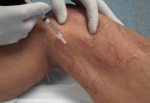 درمان وريد واريسی با تزريق يا اسكلروتراپی