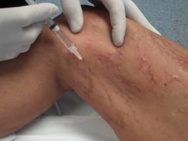درمان وريد واريسی با تزريق يا اسكلروتراپی