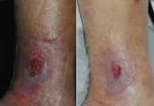 زخم وریدی پا