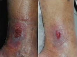 زخم وریدی پا