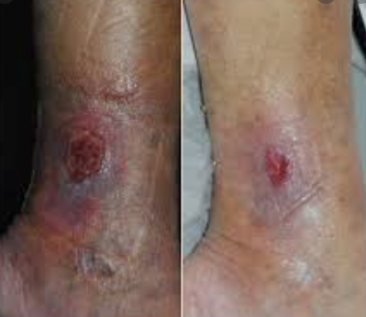 زخم وریدی پا