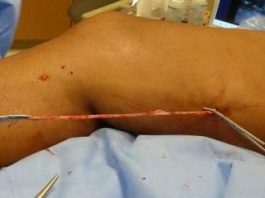 درمان جراحی وريدهای واريسی