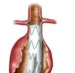 ترمیم اندوواسکولار آنوریسم آئورت شکمی (EVAR)