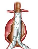 ترمیم اندوواسکولار آنوریسم آئورت شکمی (EVAR)