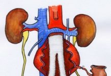 ترمیم آنوریسم آئورت شکمی با عمل جراحی باز