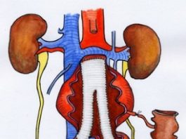 ترمیم آنوریسم آئورت شکمی با عمل جراحی باز