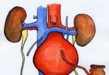 آنوریسم آئورت شکمی