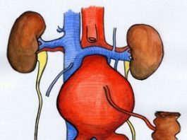 آنوریسم آئورت شکمی