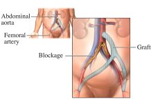 بای پس آئورتو بای فمورال و آگزیلو بای فمورال