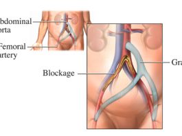 بای پس آئورتو بای فمورال و آگزیلو بای فمورال