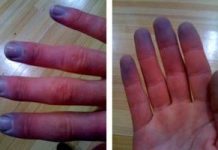 رینود، اسکلرودرمی، و اختلالات همراه