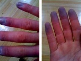 رینود، اسکلرودرمی، و اختلالات همراه