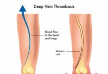 ترومبوز وریدی عمقی (DVT) و آمبولی ریوی