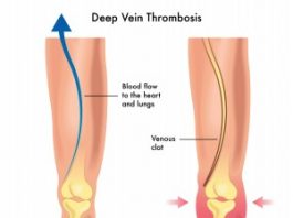 ترومبوز وریدی عمقی (DVT) و آمبولی ریوی