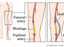 بای پس فموروپوپلیته