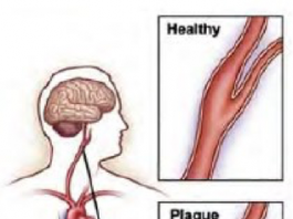 حمله ایسکمیک گذرا مغزی چیست؟
