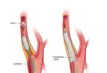 استنتینگ شریان کاروتید (CAS)