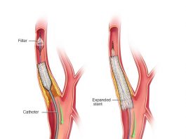 استنتینگ شریان کاروتید (CAS)