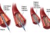 آنژیوپلاستی و استنت گذاری چیست؟