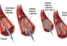 آنژیوپلاستی و استنت گذاری چیست؟