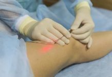 درمان وريدهای واريسی با ليزر درون وريدی